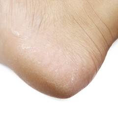 dry skin texture detail of human foot
