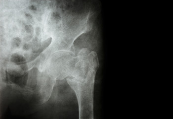 intertrochanteric ( Neck of femur ) fracture left femur