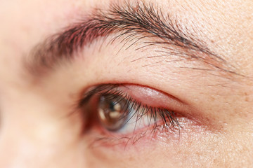 Left upper eye lid abscess 