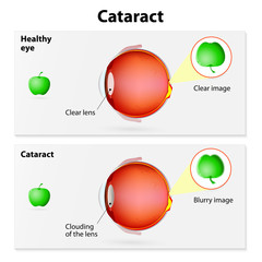 cataract