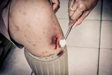 Child with scraped knee