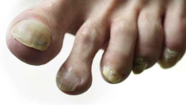 Yellow Toenails