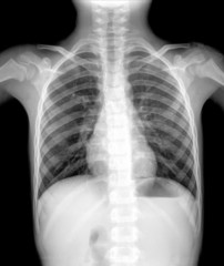 X-Ray Image Of Human Chest for a medical diagnosis