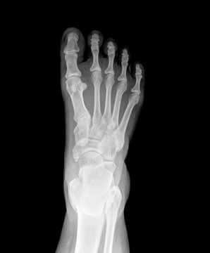 X-ray picture of foot