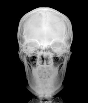 closeup image of classic xray image of skull