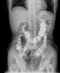 upper gastrointestinal (UGI)