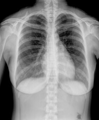 X-Ray Image Of Woman Chest for a medical diagnosis
