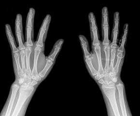 pair of hand on black background, x-ray