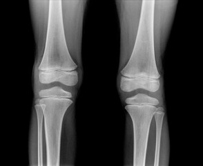 2 Knee x-ray