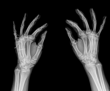 black and white photo of x-ray picture of human hands
