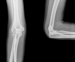 Right elbow radiography. Open and closed position
