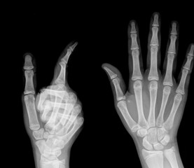 X-ray image of human hand with finger point