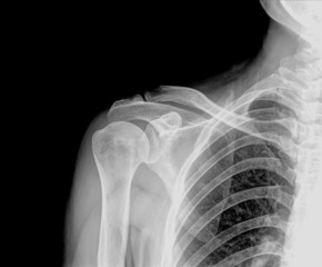 X-ray of Right human shoulder with hold 5 Kg , A C joint