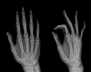 X-ray both hands with OK sign