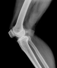 X-ray picture showing knee joints