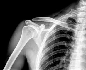 X-ray of shoulder joint