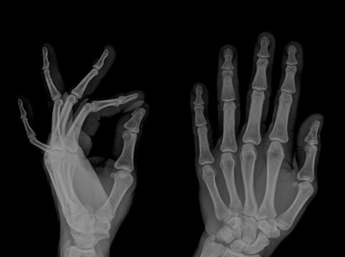 Normal Hand Rentgen รูปภาพRontgen – เลือกดูภาพถ่ายสต็อก เวกเตอร์ และวิดีโอ1,651 | Adobe Stock