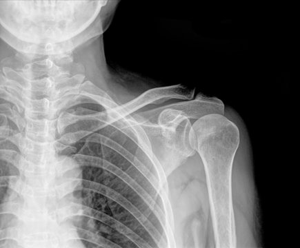X-ray of Left human shoulder with hold 5 Kg, A C joint