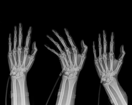 X-Ray Hand