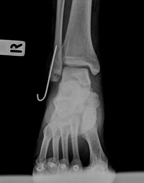 AP x-ray of injured ankle