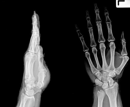 X-ray of both human arms and hands