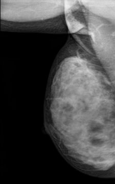 X-ray: Breast Cancer (Mamary tumor)
