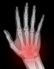 X-ray hand