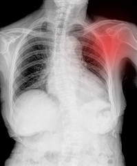 x-rays image of the painful or injury shoulder joint 
