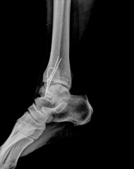 human foot ankel and leg xray picture