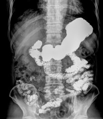 Intestine and spine x-ray