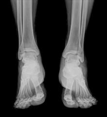 medical copy of two soles ,front view