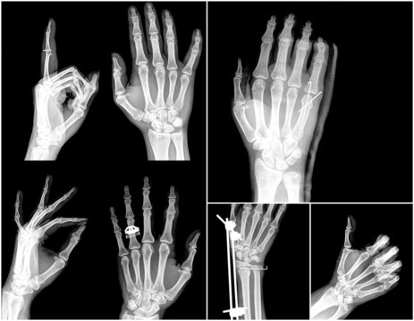 Collection x-ray of hands , high quality image