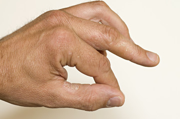 Neurodermitis Hand 607