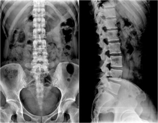 spine and pelvis of a human body on x-ray : show 2 different view