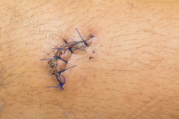 lesion