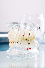 cast tooth