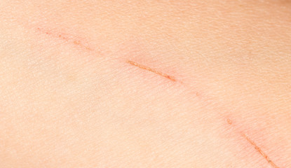 Fototapeta premium a wound on the skin