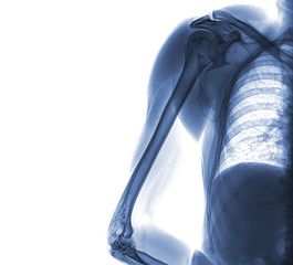 X-ray of shoulder and arm