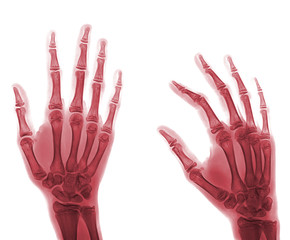 X-ray hand