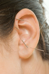 acupuncture