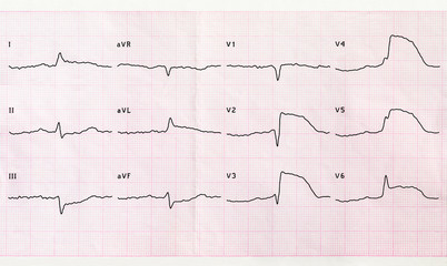 ECG with acute period macrofocal anterior myocardial infarction