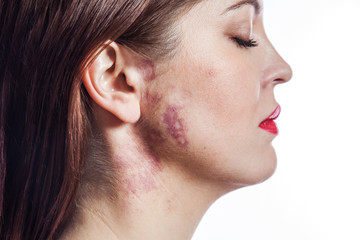 Fototapeta beautiful woman with port-wine stain (birthmark) on her face.
 obraz