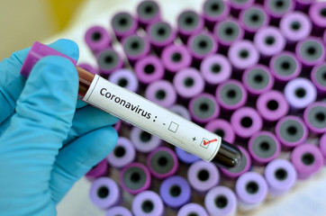Obraz premium Blood sample with Coronavirus positive