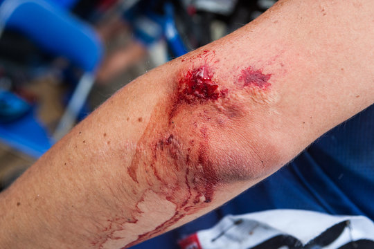 Blessure, sang