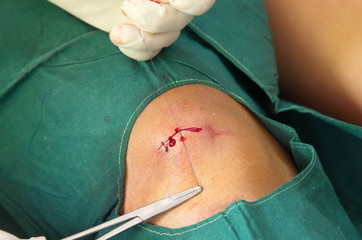 suturing wound.