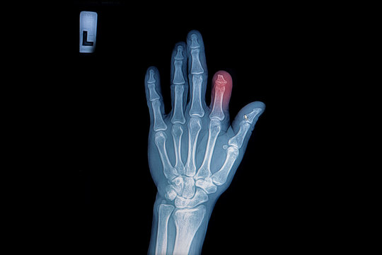 X-ray of trauma hand and finger
