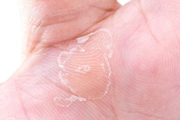Close up peeling on hand