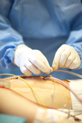 Surgeon fixing enteral tubes