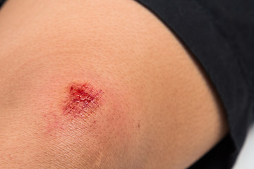 Fresh bloody bruise wound on the knee 