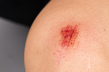 Fototapeta premium Fresh bloody bruise wound on the knee 